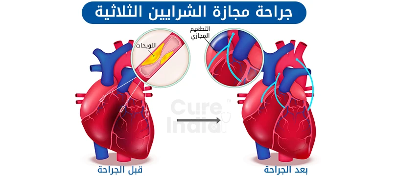 ما هي جراحة مجازة الشريان الثلاثي